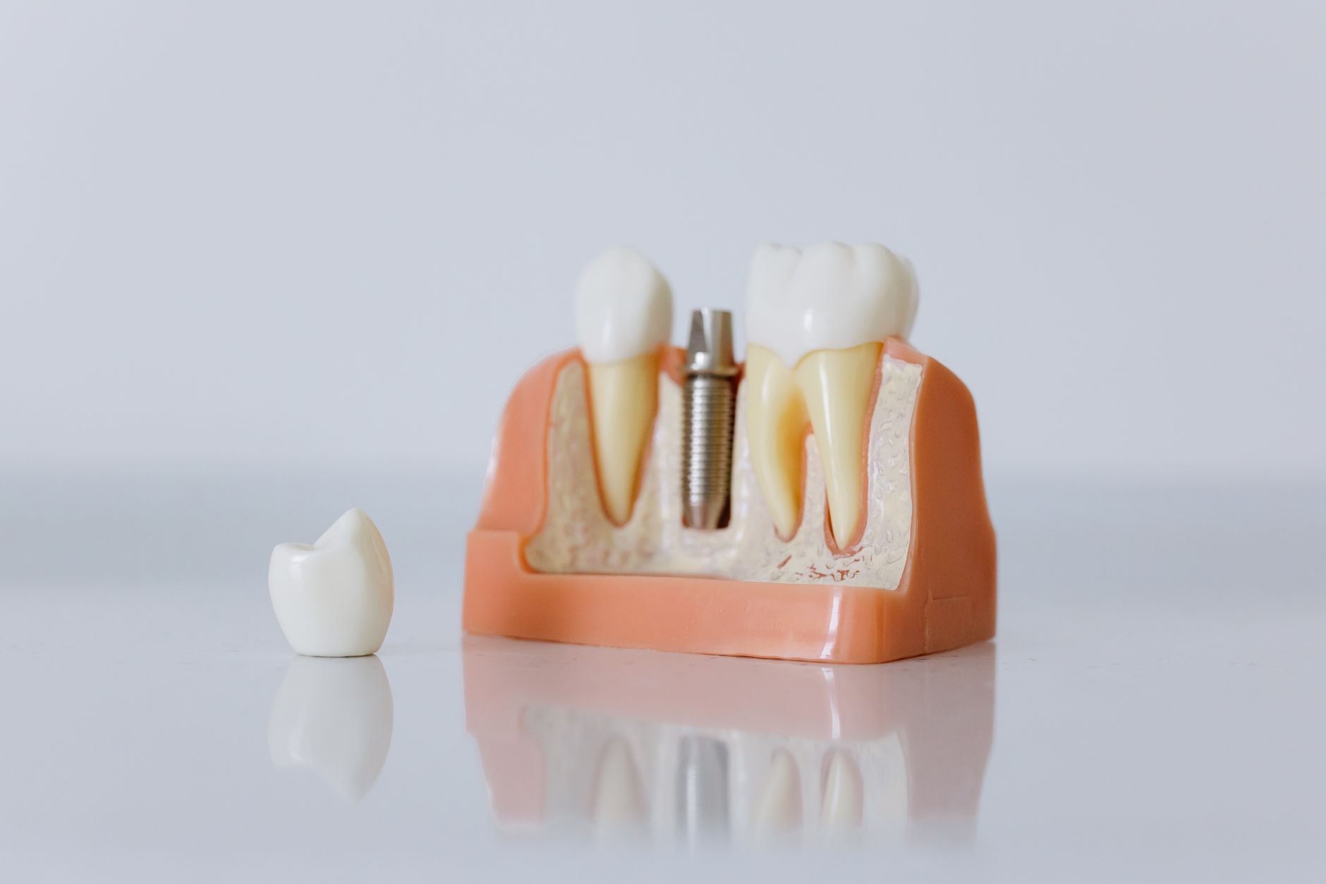 A model of a dental implant beside natural teeth, with a crown in front